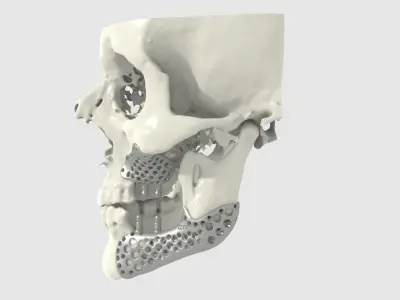 Medical implant for the reconstruction of the lower jaw 3D print model