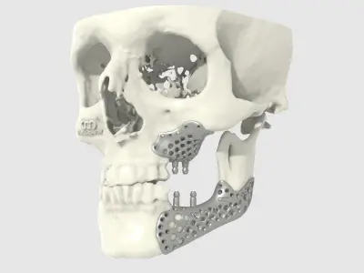 Medical implant for the reconstruction of the lower jaw 3D print model