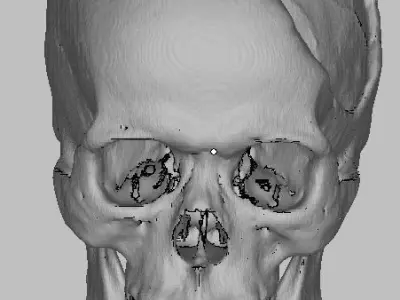My Skull defect from car accident STL from CT Scan data 3D model