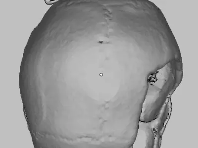 My Skull defect from car accident STL from CT Scan data 3D model
