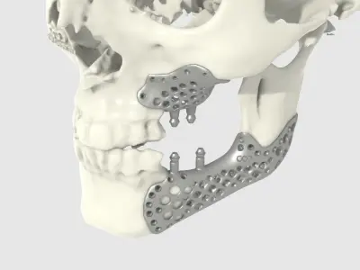 Medical implant for the reconstruction of the lower jaw 3D print model