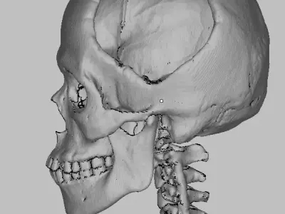 My Skull defect from car accident STL from CT Scan data 3D model