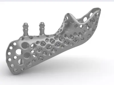 Medical implant for the reconstruction of the lower jaw 3D print model