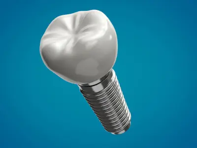 Tooth Implant  3D model