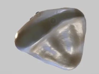 White Spot Lesions Low-poly 3D model