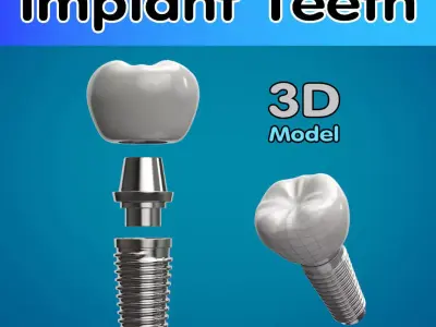 Tooth Implant  3D model
