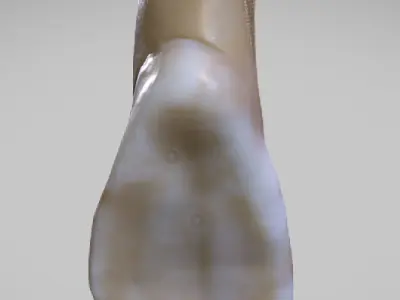 White Spot Lesions Low-poly 3D model