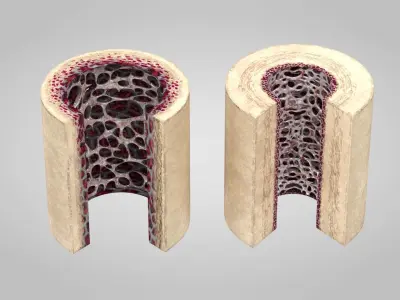 Healthy and Osteoporotic Bone Section 3D model