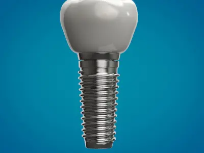 Tooth Implant  3D model