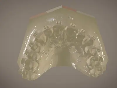 Digital Orthodontic Indirect Bonding Tray 3D print model