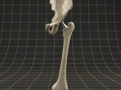 Femoral prosthesis femur and pelvic gilder  3D model