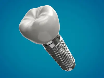 Tooth Implant  3D model