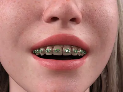 HX Braces for Genesis 9