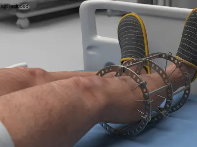  Patient with Ilizarov Apparatus on Bed 