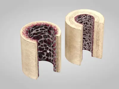 Healthy and Osteoporotic Bone Section 3D model