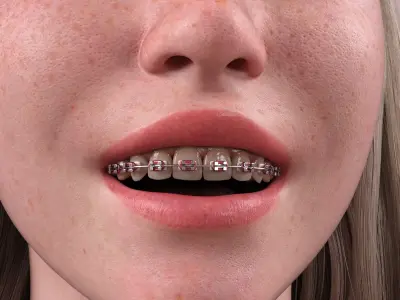 HX Braces for Genesis 9