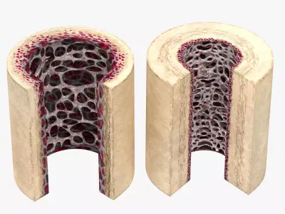 Healthy and Osteoporotic Bone Section 3D model