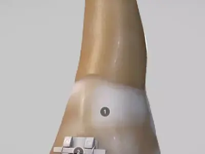 White Spot Lesions Low-poly 3D model