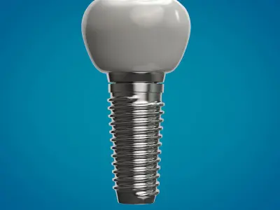 Tooth Implant  3D model