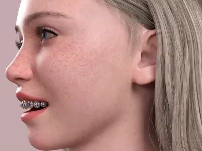 HX Braces for Genesis 9