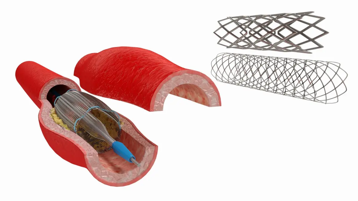 Stents with Artery 3D model