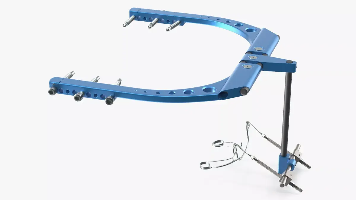 Rigid Distraction Frame for Cranial Surgery Blue 3D model