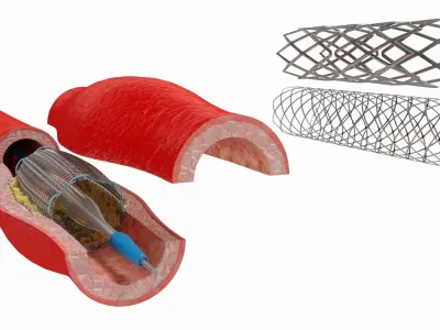 Stents with Artery 3D model