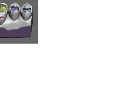 Dental Model For Composite Filling training 3D print model