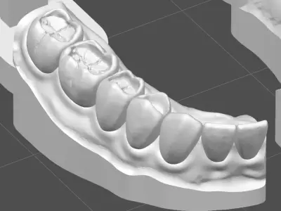 Occlusal Restoration Training Models  Upper and Lower 3D print model