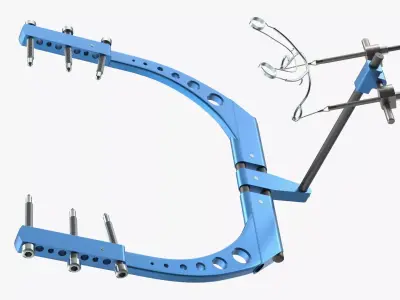 Rigid Distraction Frame for Cranial Surgery Blue 3D model