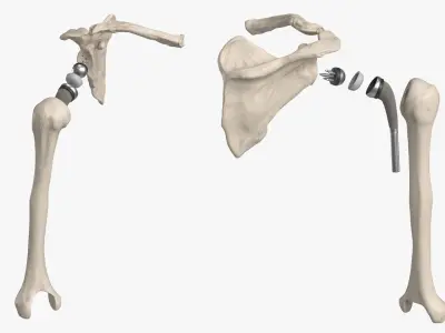 Shoulder Joint Implant with Humerus and Scapula 