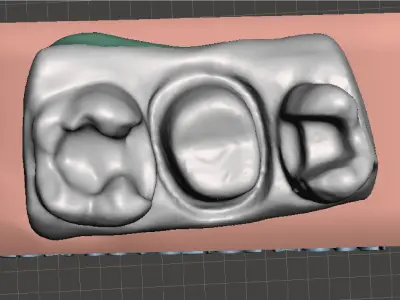 EDM Dental Practice Standard Model Class 2 and Bridge 3D print model