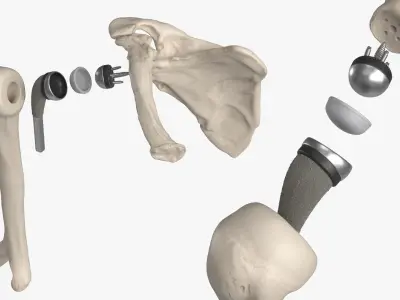  Shoulder Joint Implant with Humerus and Scapula 