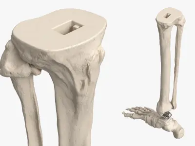  Ankle Joint Implant with Tibia Fibula and Foot Bones 