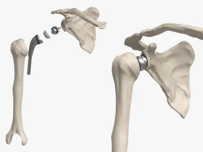  Shoulder Joint Implant with Humerus and Scapula 