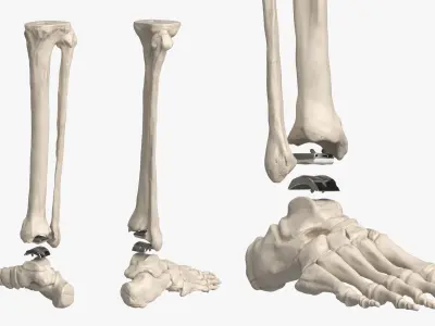  Ankle Joint Implant with Tibia Fibula and Foot Bones 
