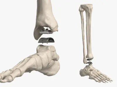  Ankle Joint Implant with Tibia Fibula and Foot Bones 