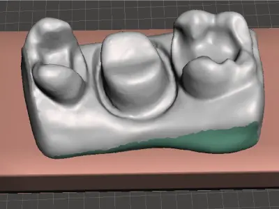 EDM Dental Practice Standard Model Class 2 and Bridge 3D print model