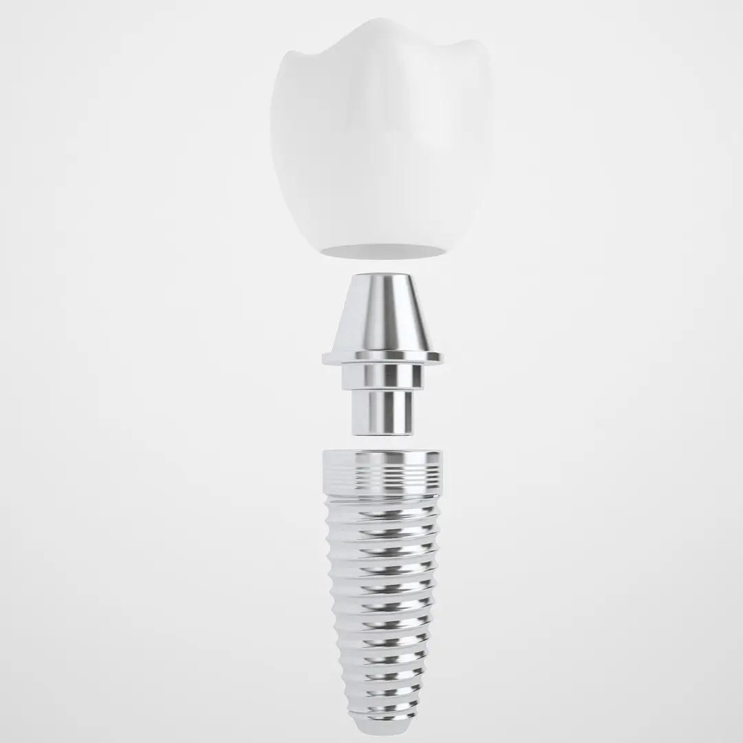 Implant Teeth 02 3D model