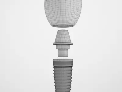 Implant Teeth 02 3D model
