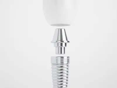 Implant Teeth 02 3D model